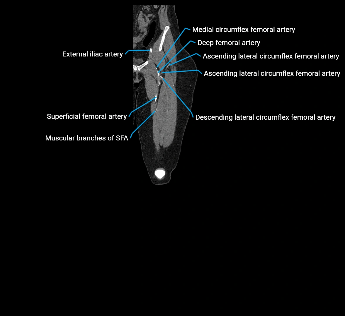 CTA lower limb coronal cross sectional anatomy labelled image _19 (2).webp